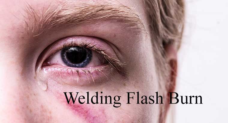 Welding Eye Burn Why Do Eyes Hurt After Welding What To Do